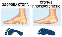 Позбавляємося болю в ногах: лікування плоскостопості в Києві — koleno.com.ua