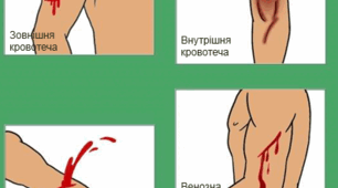 Поняття про рану. Кровотечі