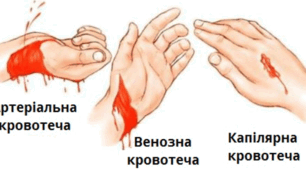  Перша допомога при кровотечах