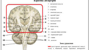 Схеми "Дизартрія. Зони ураження. Симптоматика"