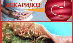 Аскаридоз: симптоми, діагностика, профілактика – ЦПМСД №7 м.Миколаїв