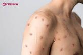 Вірус мавпячої віспи: що варто знати? - Гречка - Новини Кропивницький